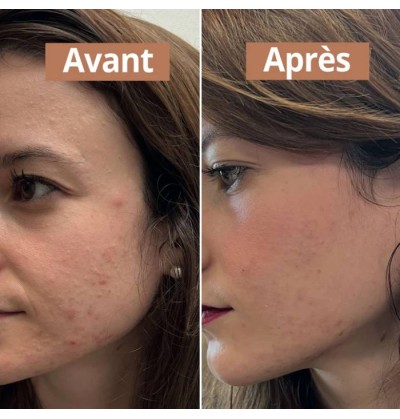 Routine soin peaux à imperfections - Comme Avant